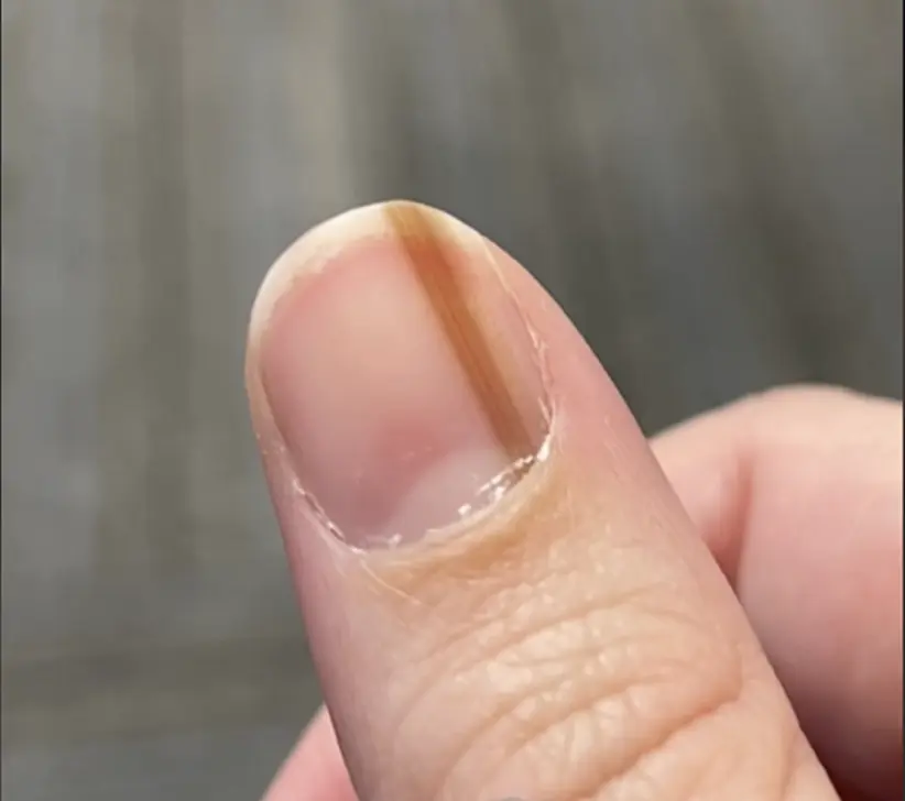 "Ung thư móng tay" Một phụ nữ phát hiện một đường màu nâu trên móng tay. Bác sĩ đưa ra lời giải thích gây sốc (video clip)
