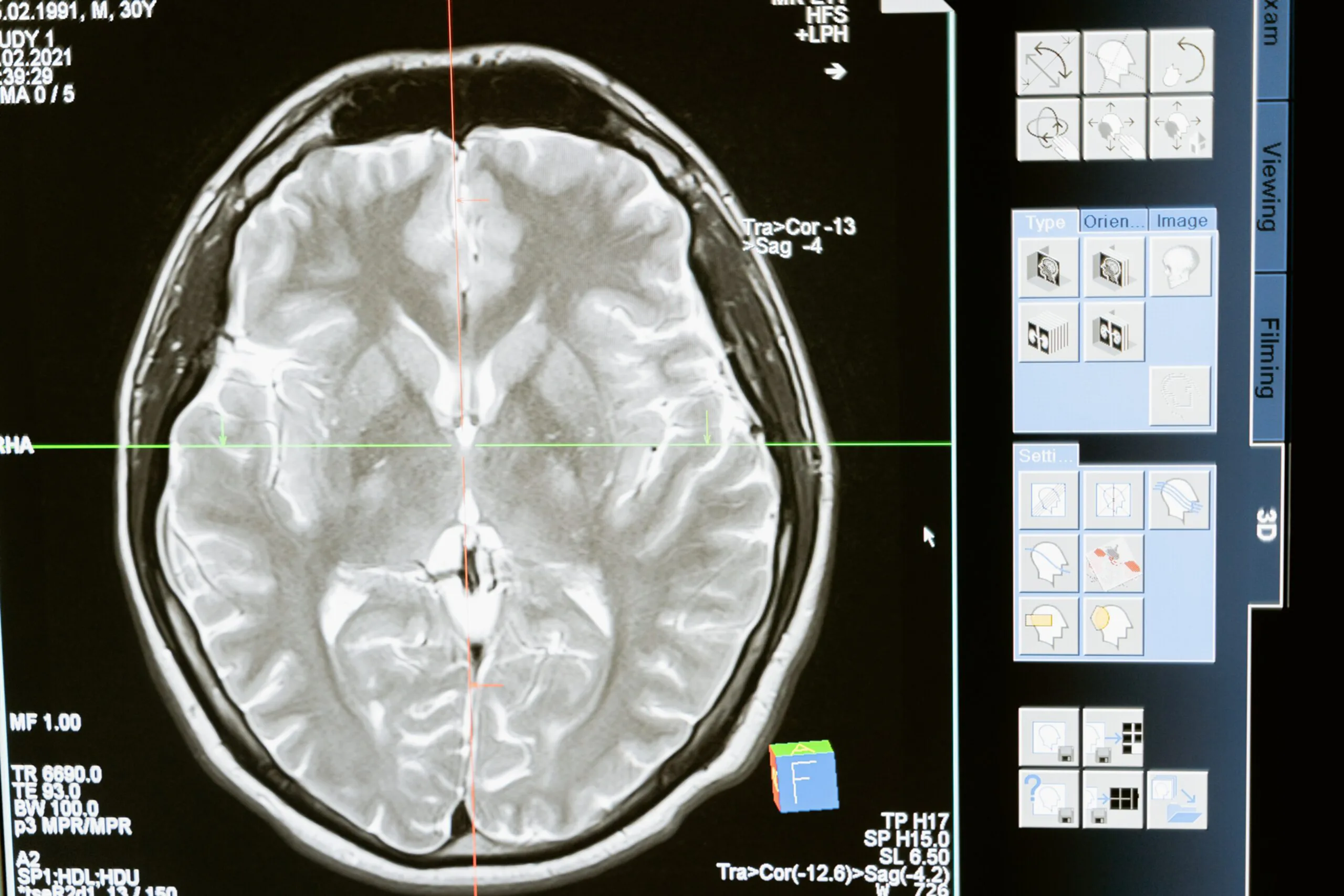 Aphasia คือ, บรูซ วิลลิส