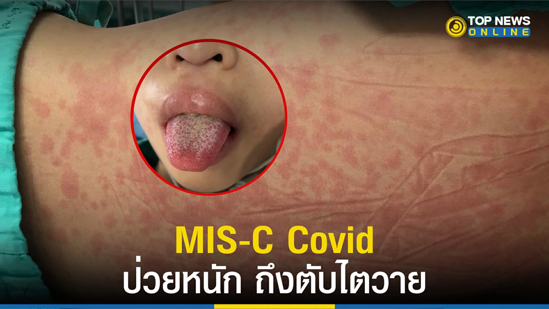mis c covid, ภาวะมิสซี, MIS-C, เด็กติดโควิด