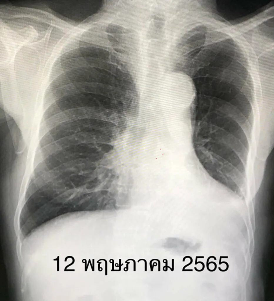 มะเร็งปอด 3A, มะเร็งปอดระยะลุกลาม, มะเร็ง, มะเร็งปอด, ต่อมน้ำเหลือง, หมอมนูญ