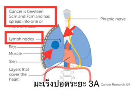 มะเร็งปอด 3A, มะเร็งปอดระยะลุกลาม, มะเร็ง, มะเร็งปอด, ต่อมน้ำเหลือง, หมอมนูญ