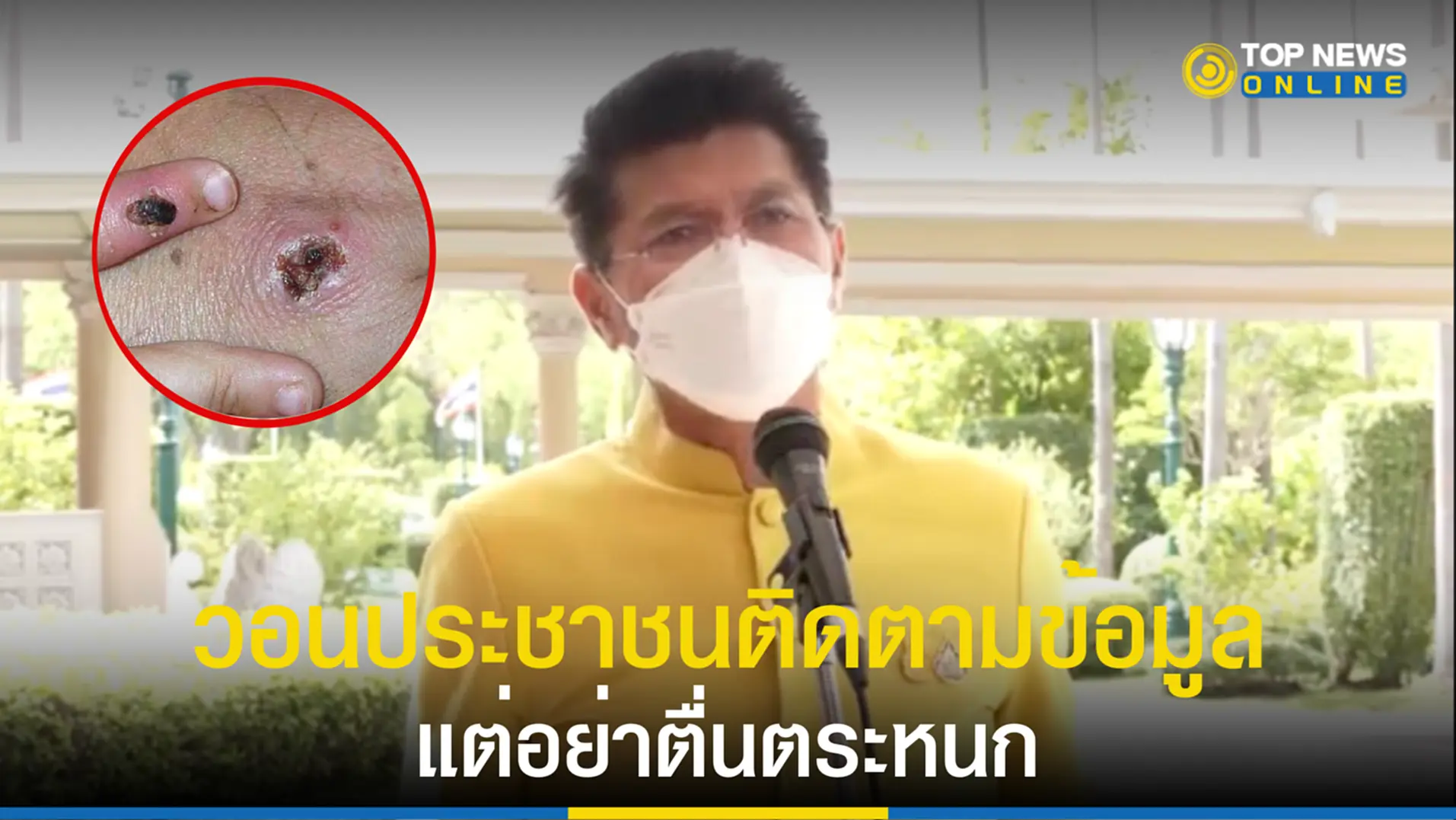 ฝีดาษลิง, monkeypox, โรคฝีดาษลิง, สธ., ปลูกฝี, คณะกรรมการปฏิบัติการในสถานการณ์