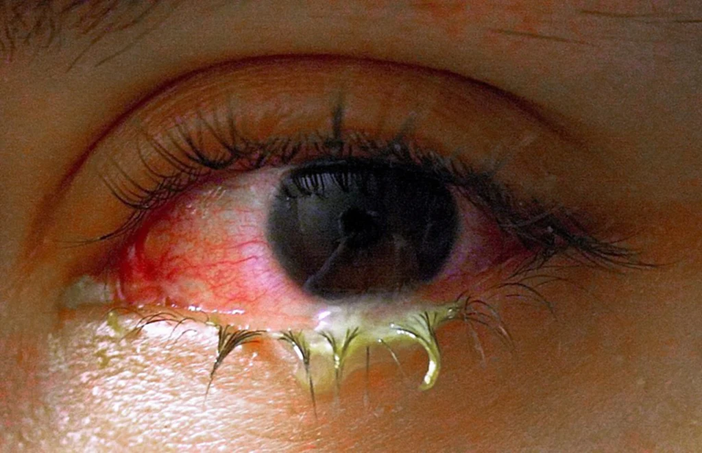 ตาแดง,​โรคตาแดง,​สุขภาพดวงตา, หน้าฝน, สาเหตุการระบาด, วิธีป้องกัน, วิธีรักษา, จักษุแพทย์, กรมการแพทย์