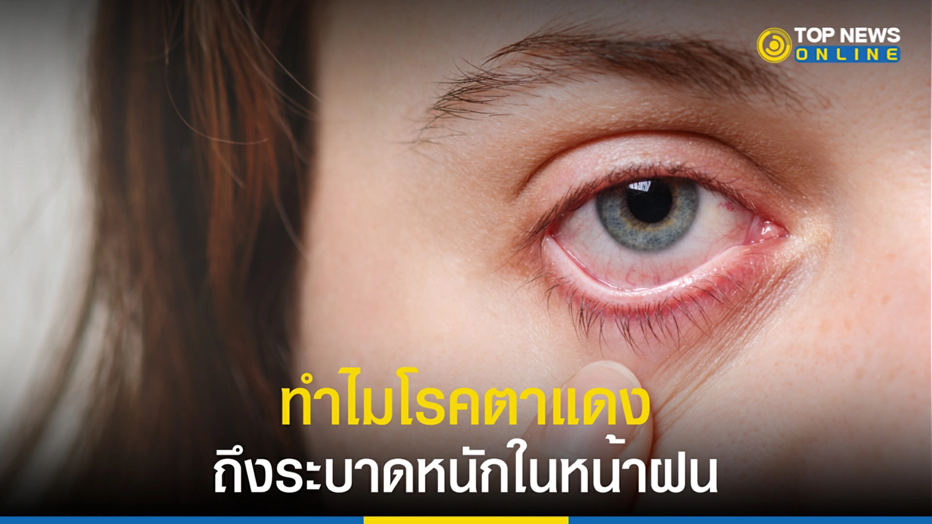 ตาแดง,โรคตาแดง,สุขภาพดวงตา, หน้าฝน, สาเหตุการระบาด, วิธีป้องกัน, วิธีรักษา, จักษุแพทย์, กรมการแพทย์