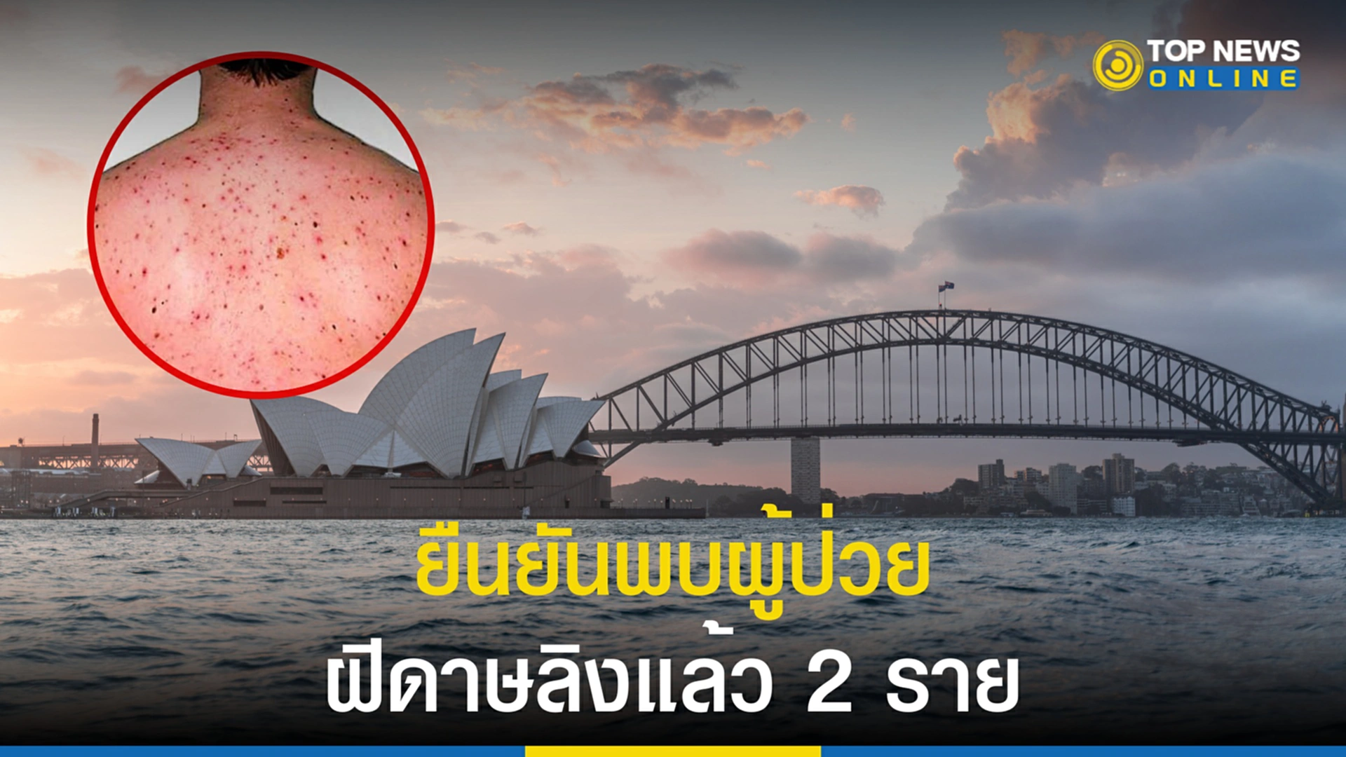 ฝีดาษลิง, โรคฝีดาษลิง, ออสเตรเลีย, อังกฤษ, ยุโรป, ฝีดาษคน
