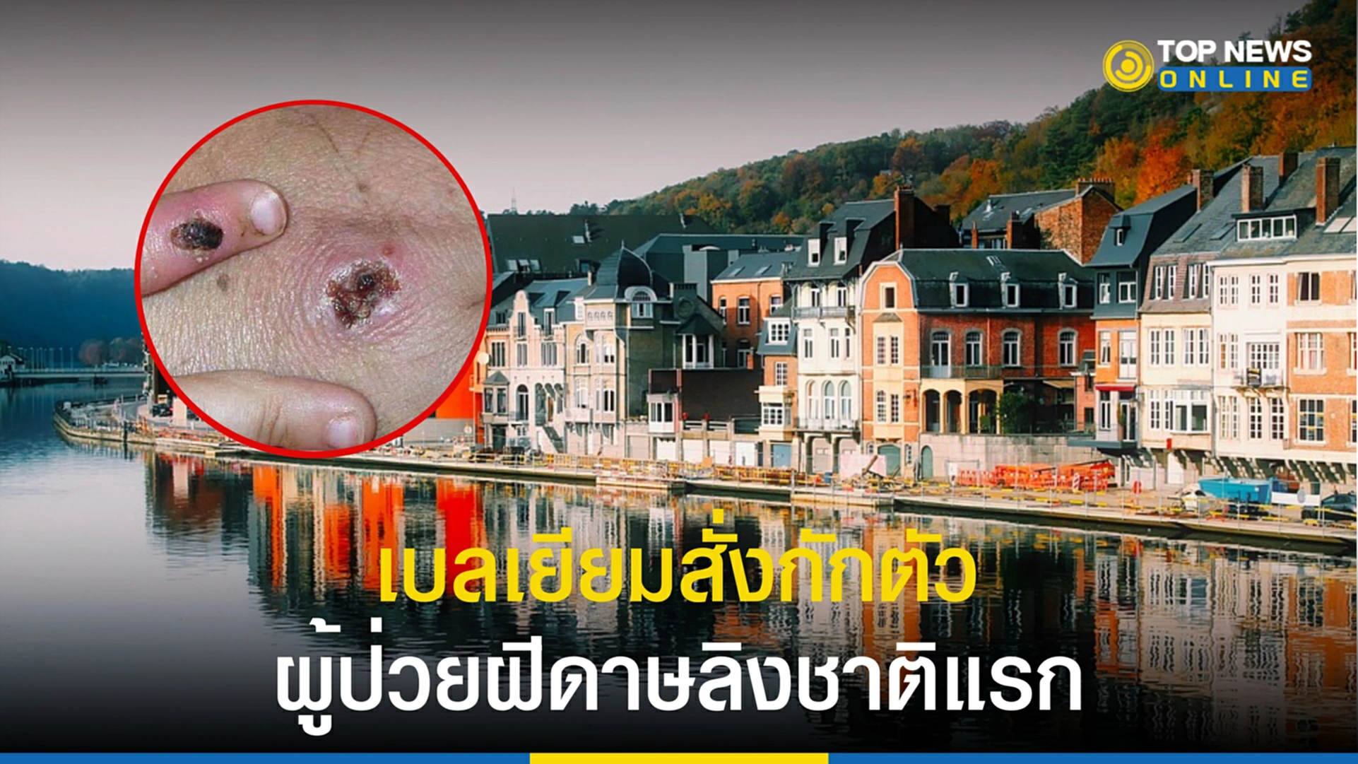 ฝีดาษลิง, โรคฝีดาษ, เบลเยียม, กักตัว, WHO, องค์ดารอนามัยโลก