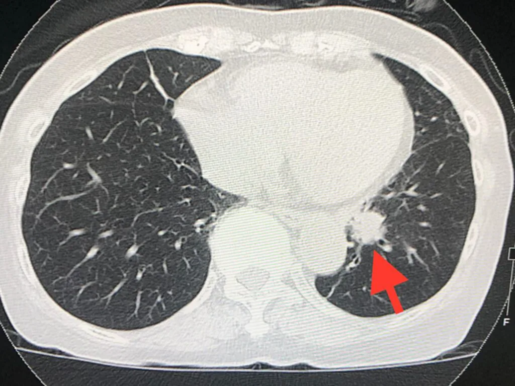 มะเร็งปอด, Chest x-ray, CT scan, Low dose CT scan, หมอมนูญ, ตรวจคัดกรอง, เสียชีวิต