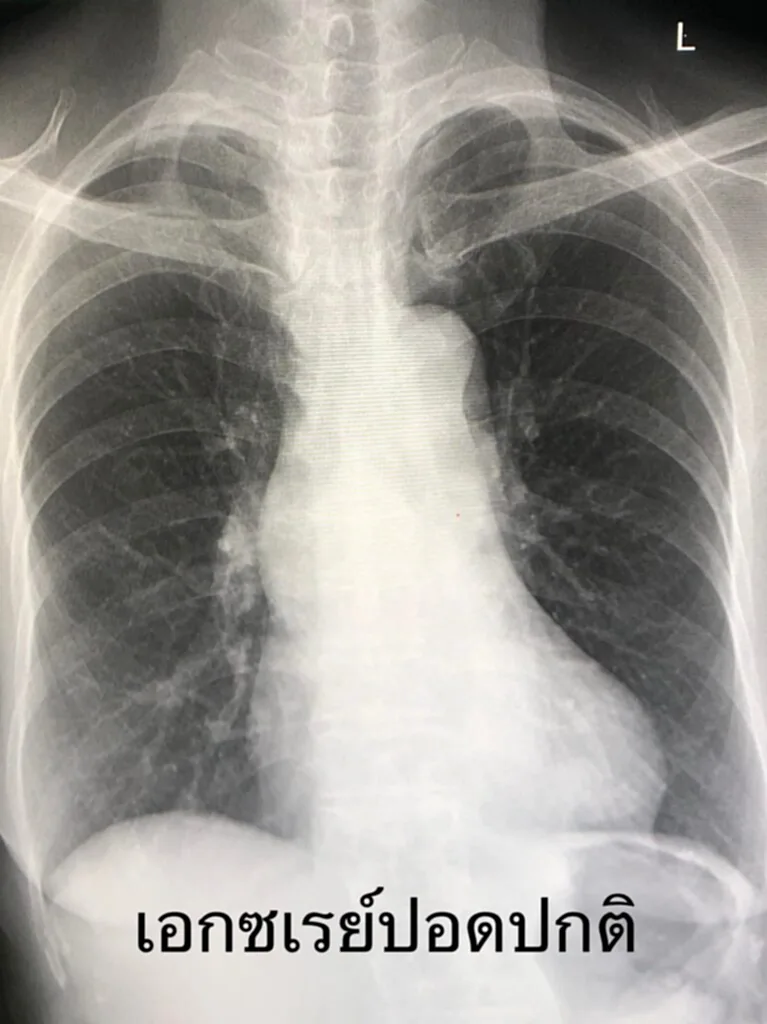 มะเร็งปอด, Chest x-ray, CT scan, Low dose CT scan, หมอมนูญ, ตรวจคัดกรอง, เสียชีวิต