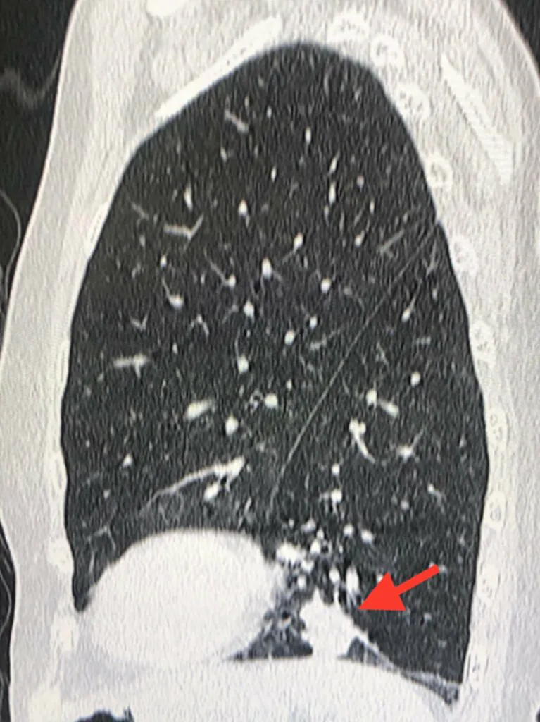 มะเร็งปอด, Chest x-ray, CT scan, Low dose CT scan, หมอมนูญ, ตรวจคัดกรอง, เสียชีวิต