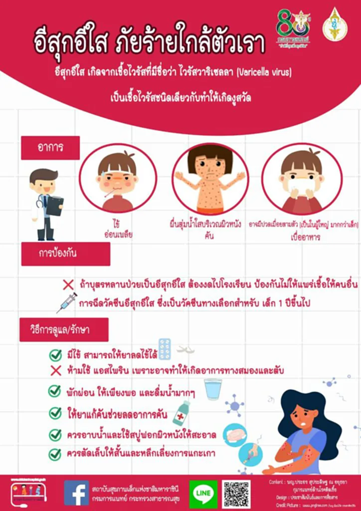 อีสุกอีใส,​โรคอีสุกอีใส, ป้องกันอีสุกอีใส, อาการอีสุกอีใส, วิธีรักษาอีสุกอีใส, อีสุกอีใสอาบน้ำได้ไหม, แอสไพริน