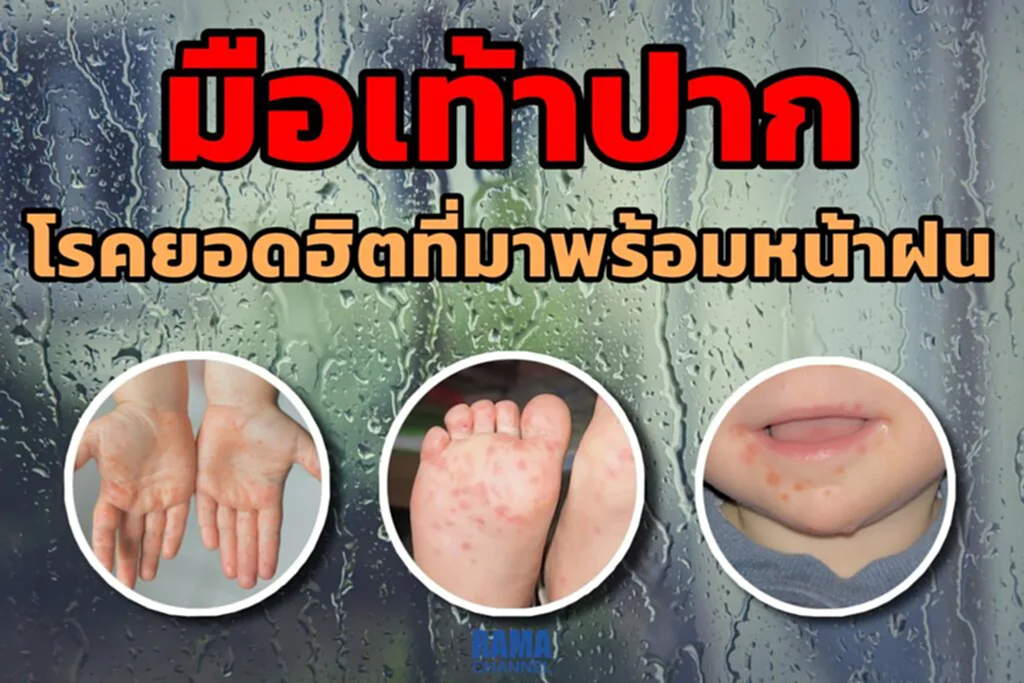 โรคมือ เท้า และปาก, โรคมือ เท้า ปาก, สาเหตุของโรค, โรคหน้าฝน, ผศ. นพ.ชนเมธ เตชะแสนศิริ, วิธีป้องกันโรค