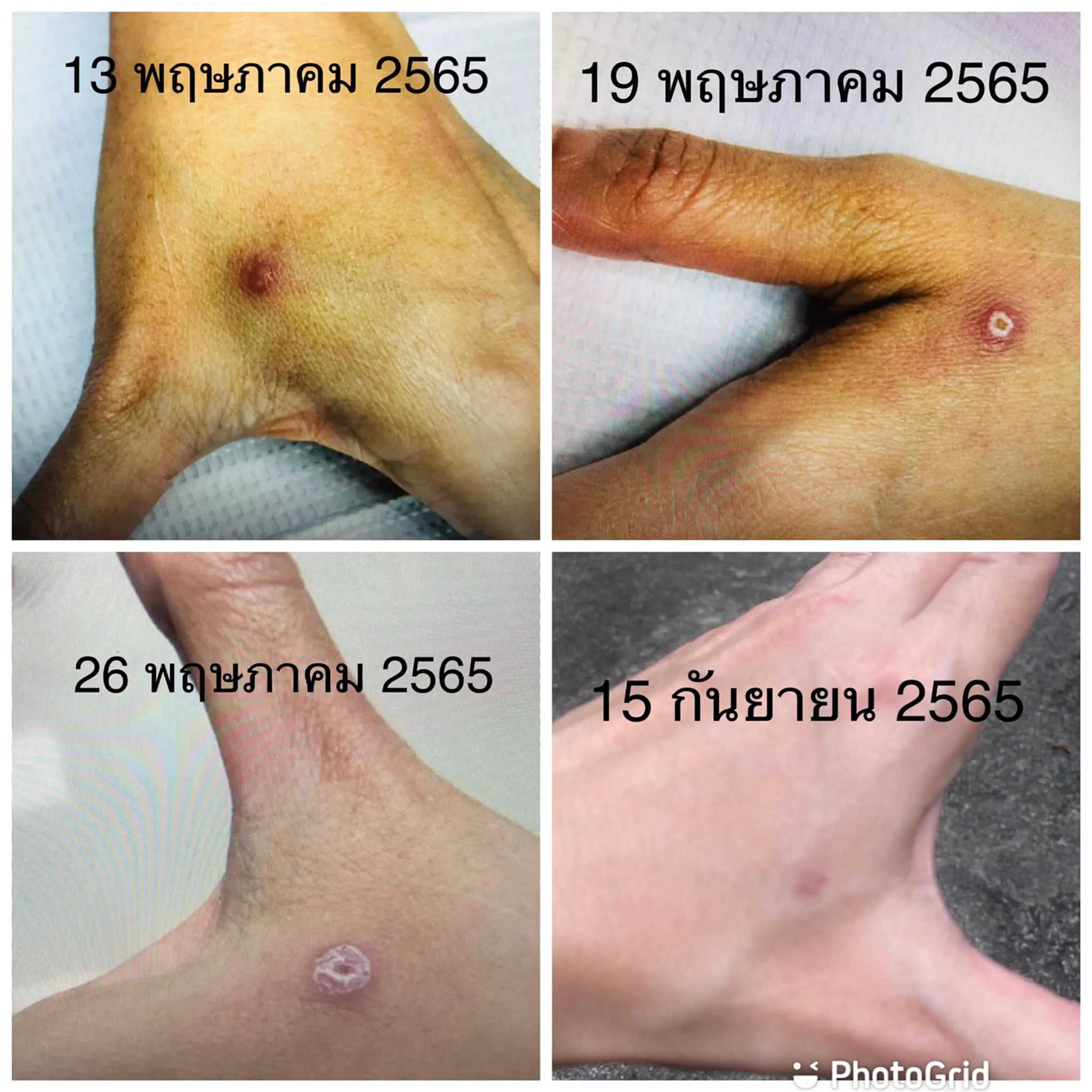 โรคสปอโรทริโคสิส, สปอโรทริโคสิส, Sporotrichosis, Sporothrix schenckii, Itraconazole, หนามกุหลาบ, แมว, ข่วน, กัด, ทาสแมว, หมอมนูญ