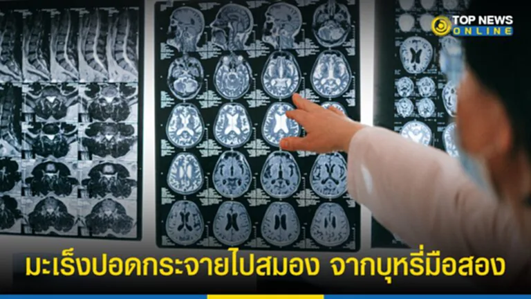 โรคระบบประสาทและสมอง, มะเร็งปอด, ควันบุหรี่, ผศ. นพ.สุรัตน์ ตันประเวช, รอยโรคในสมอ, อาการ ของ มะเร็ง ปอด