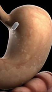 แคปซูลจิ๋วตรวจกระเพาะ